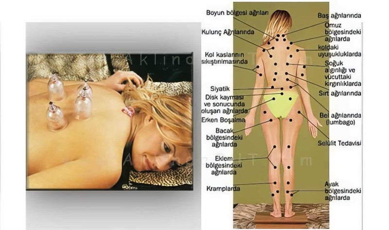 12 Parça Vakumlu Hacamat Kupa Çekme Seti Hacamax 1. Kalite - 3