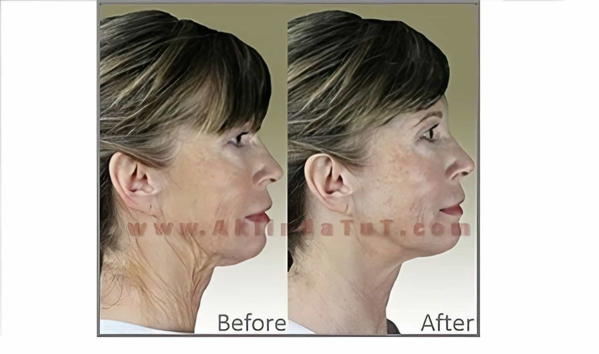 Derma Wand High Frekans Termal Enerji Cilt Bakım Cihazı Anti Aging - (yüz Ütüsü) - 4