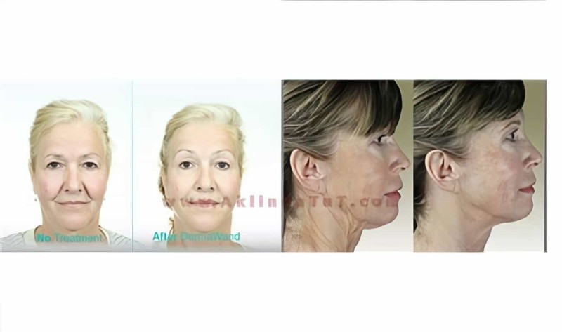 Derma Wand High Frekans Termal Enerji Cilt Bakım Cihazı Anti Aging - (yüz Ütüsü) - 5