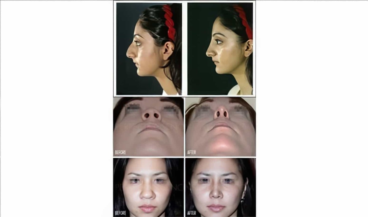 Nose Up Burun Şekillendirici Ve Kaldırıcı - 6