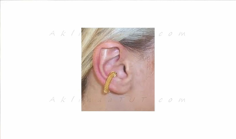 Zayıflatıcı Akupunktur Bio Zayıflama Küpesi - 2